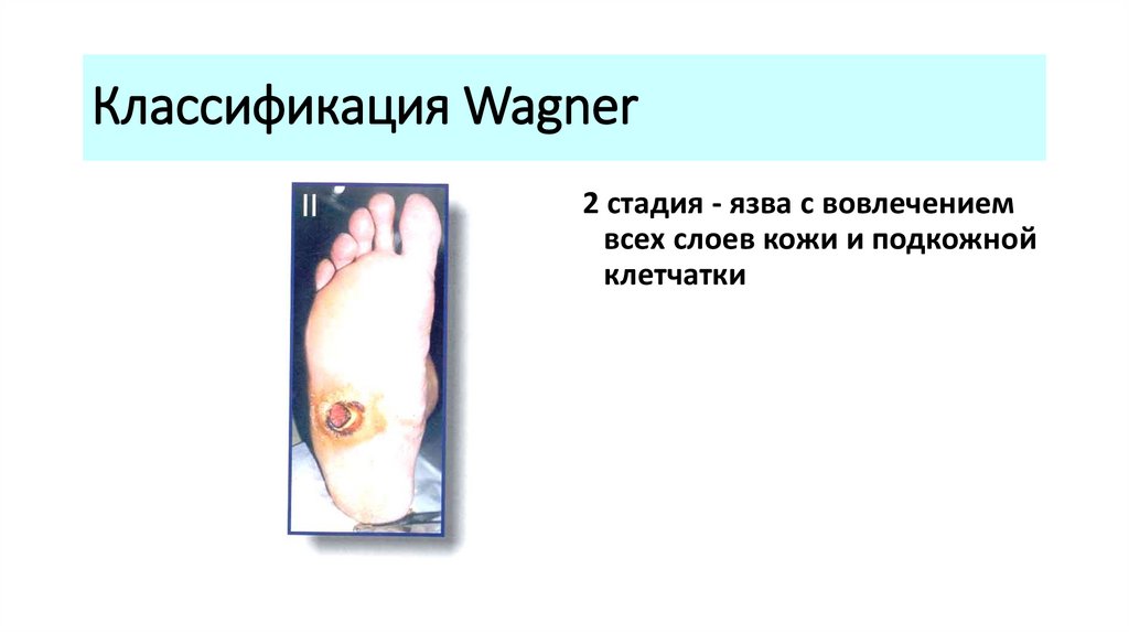 Классификация Wagner