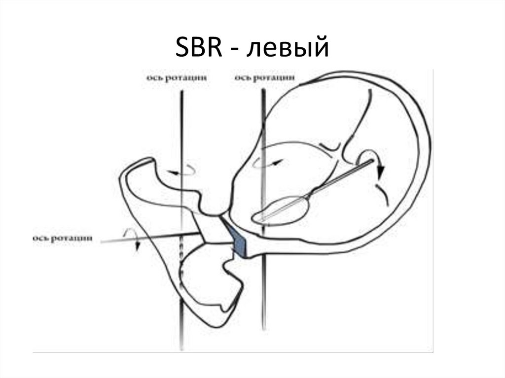 Боковой наклон с ротацией (SBR)