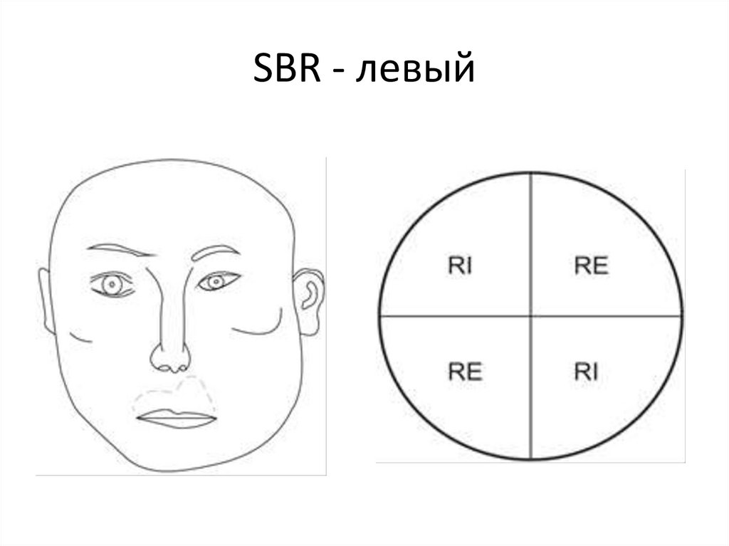 Боковой наклон с ротацией (side bend, rotation = SBR)