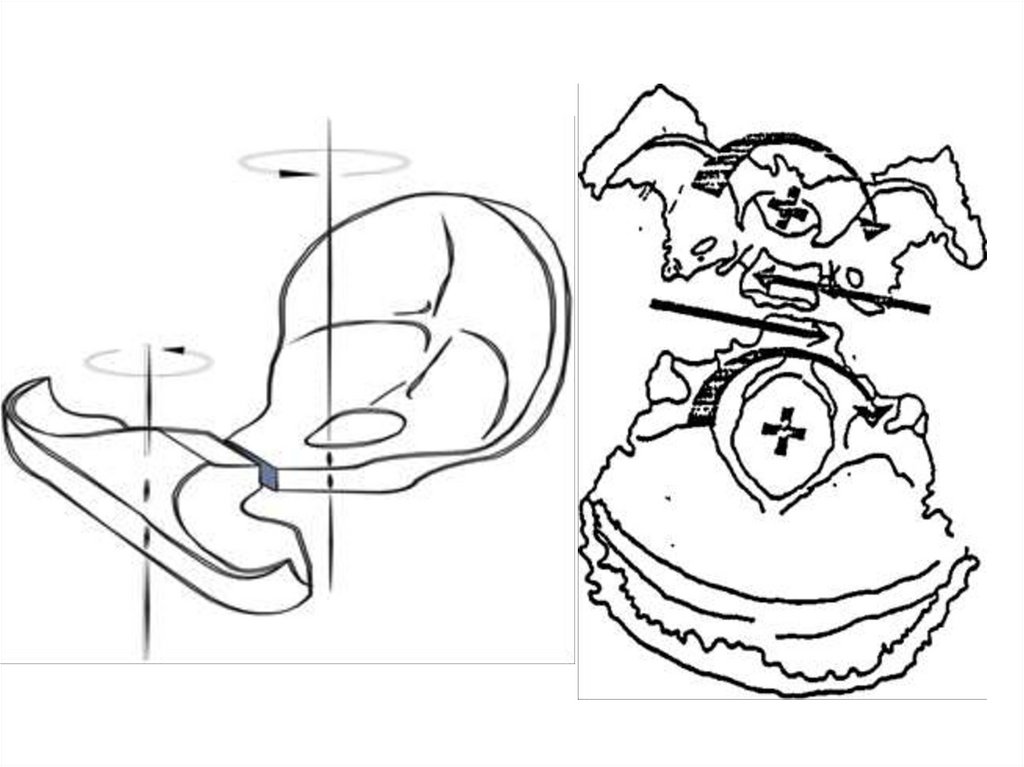 Латеральный стрейн (левый, правый).