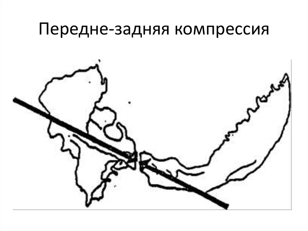 Компрессия СБС