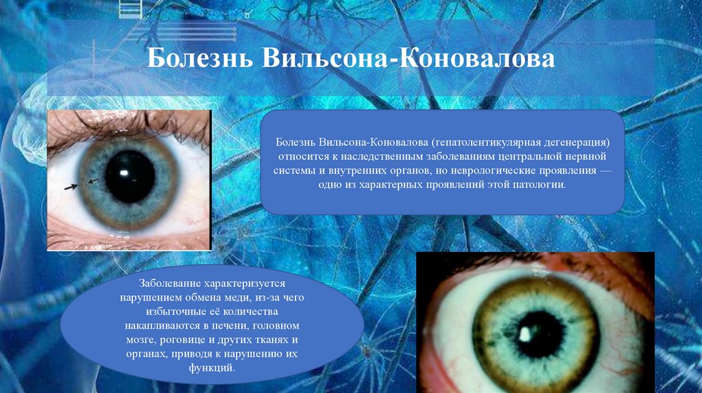 Болезнь Вильсона-Коновалова