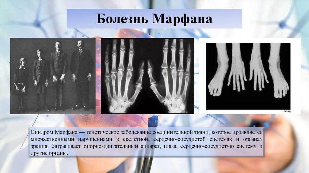 Болезнь Марфана