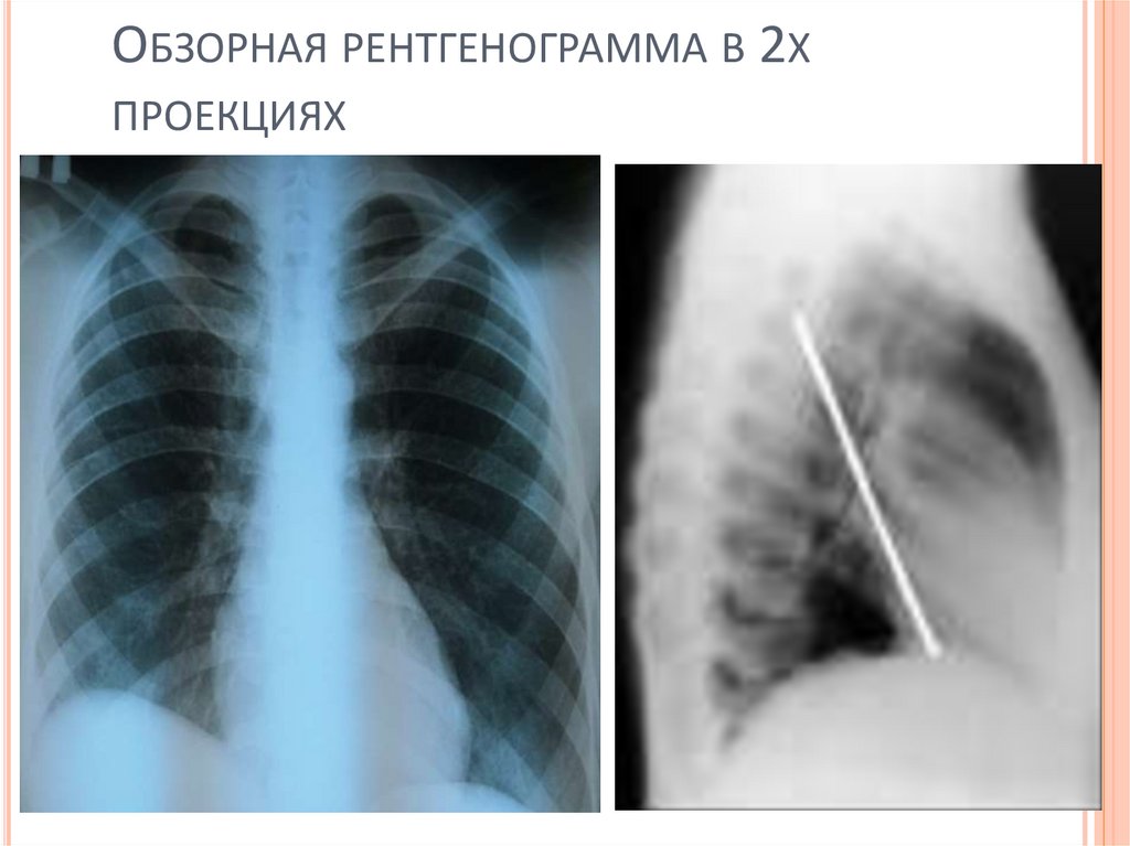 Обзорная рентгенограмма в 2х проекциях