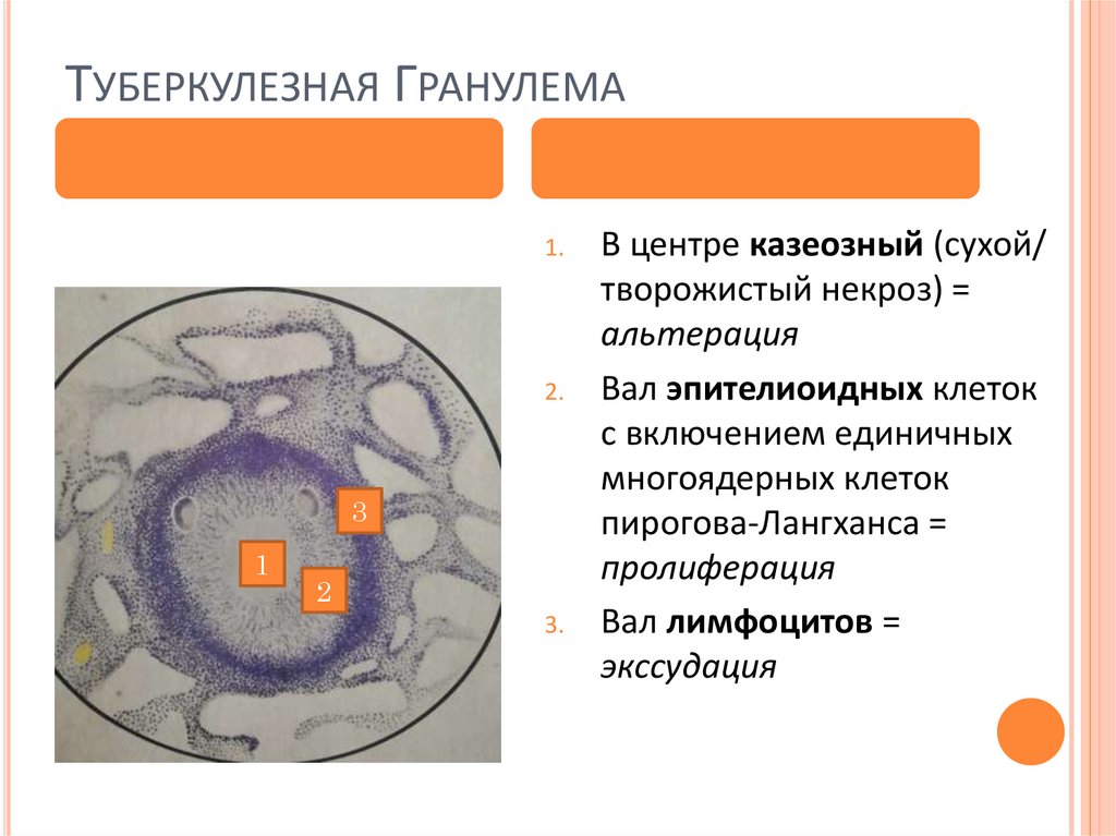 Туберкулезная Гранулема