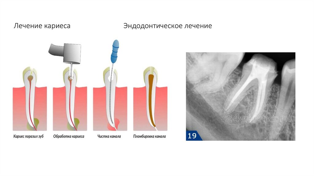 Лечение кариеса Эндодонтическое лечение