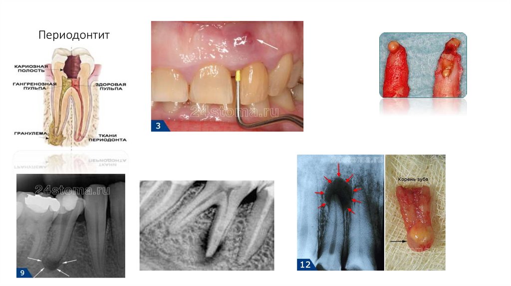 Периодонтит