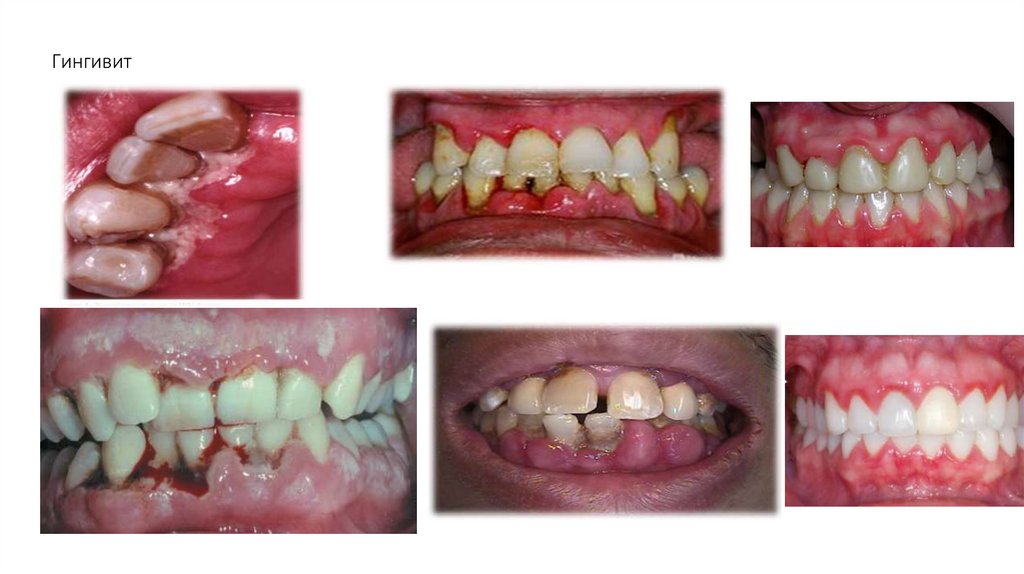 Гингивит