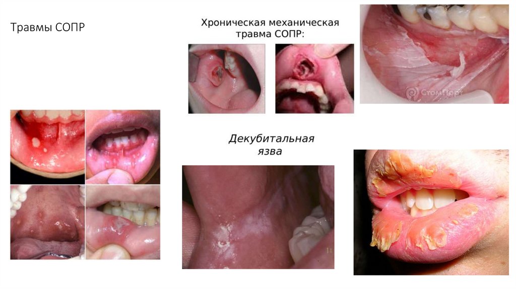 Травмы СОПР