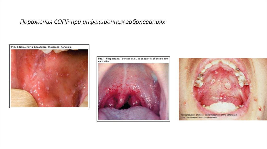 Поражения СОПР при инфекционных заболеваниях