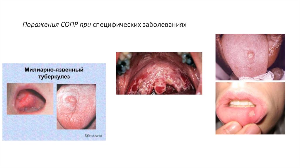 Поражения СОПР при специфических заболеваниях