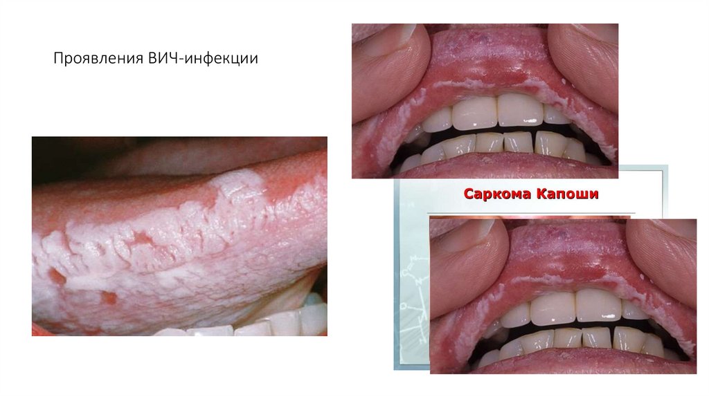 Проявления ВИЧ-инфекции