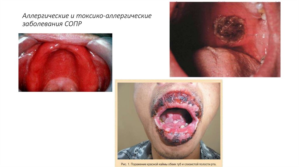 Аллергические и токсико-аллергические заболевания СОПР