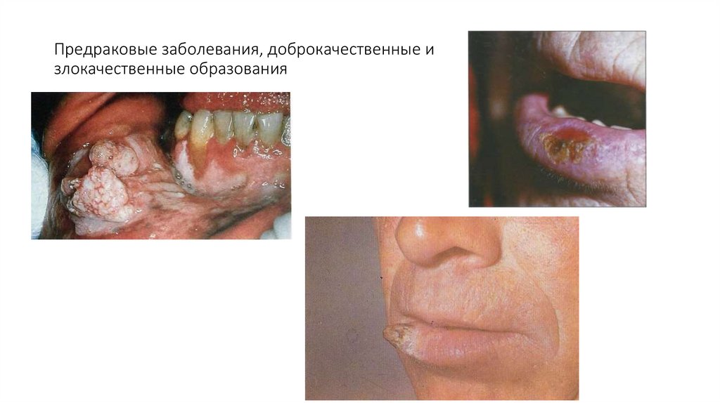 Предраковые заболевания, доброкачественные и злокачественные образования