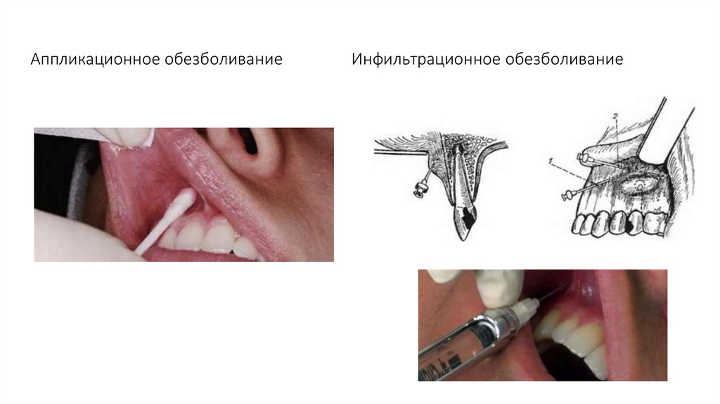 Аппликационное обезболивание Инфильтрационное обезболивание