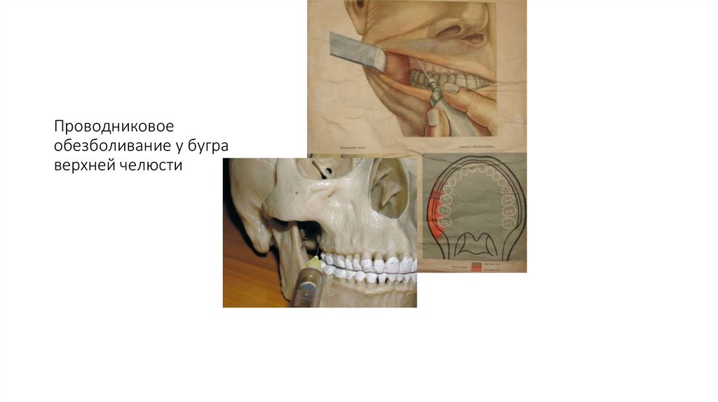 Проводниковое обезболивание у бугра верхней челюсти