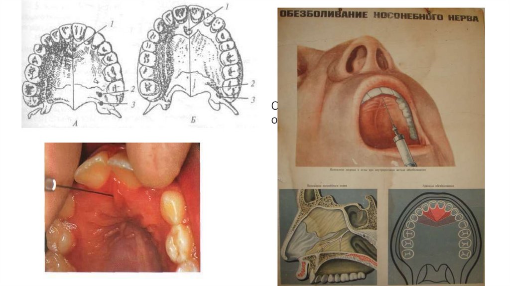 Обезболивание у резцового отверстия