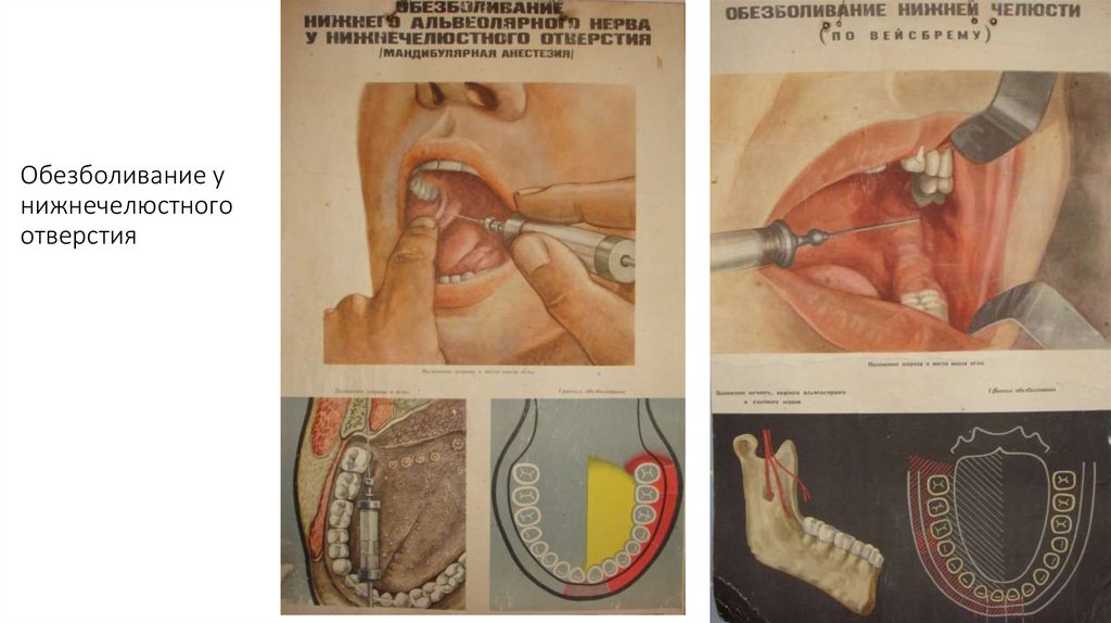 Обезболивание у нижнечелюстного отверстия