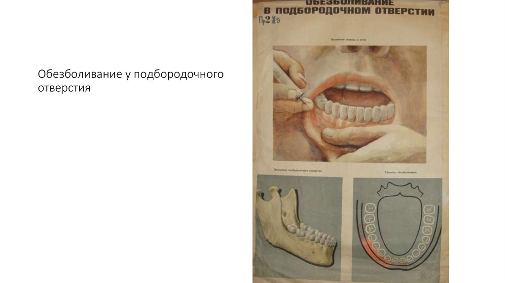 Обезболивание у подбородочного отверстия