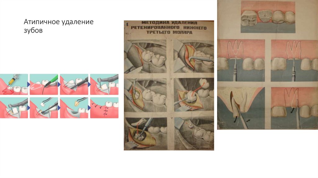 Атипичное удаление зубов