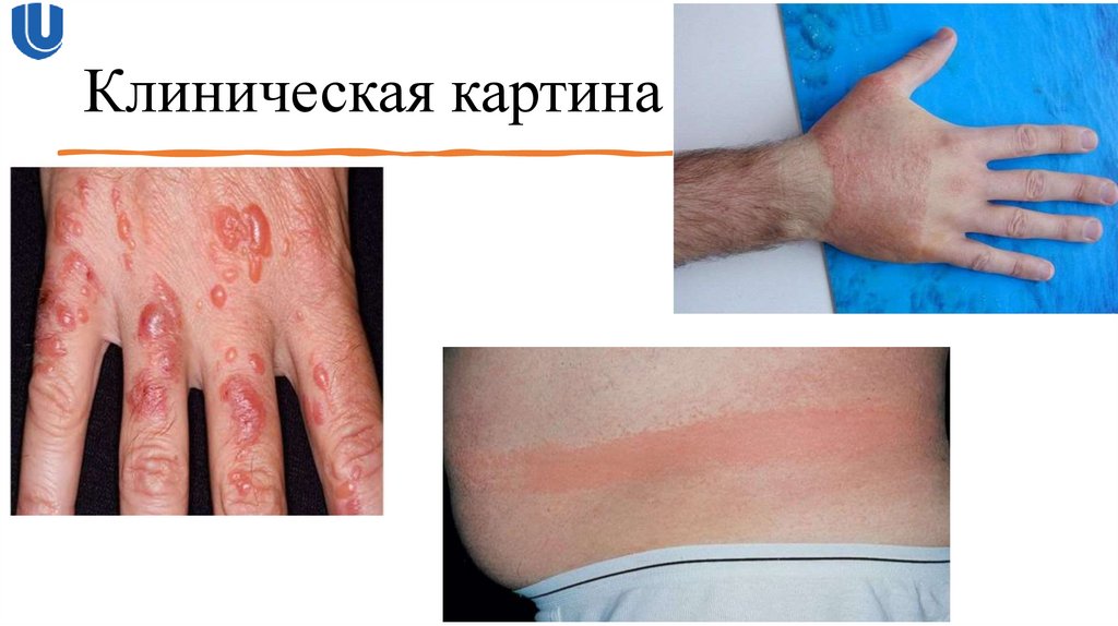 Клиническая картина