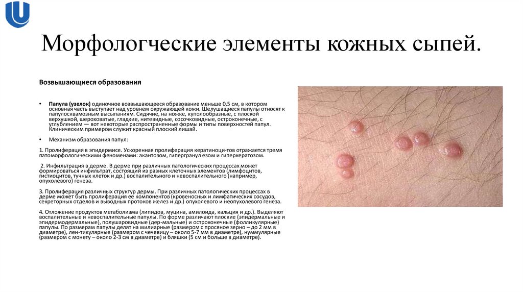 Морфологческие элементы кожных сыпей.