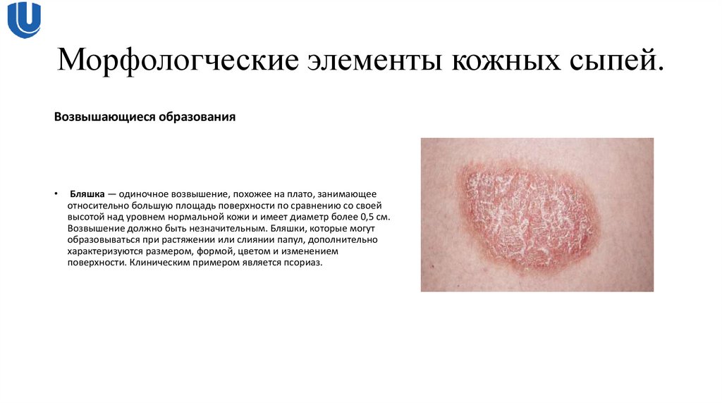 Морфологческие элементы кожных сыпей.