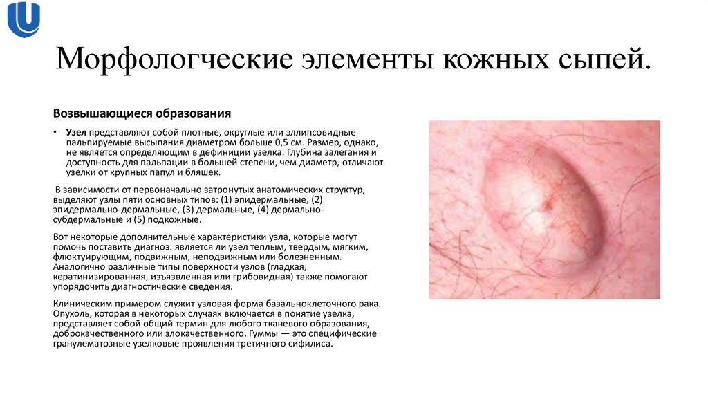 Морфологческие элементы кожных сыпей.