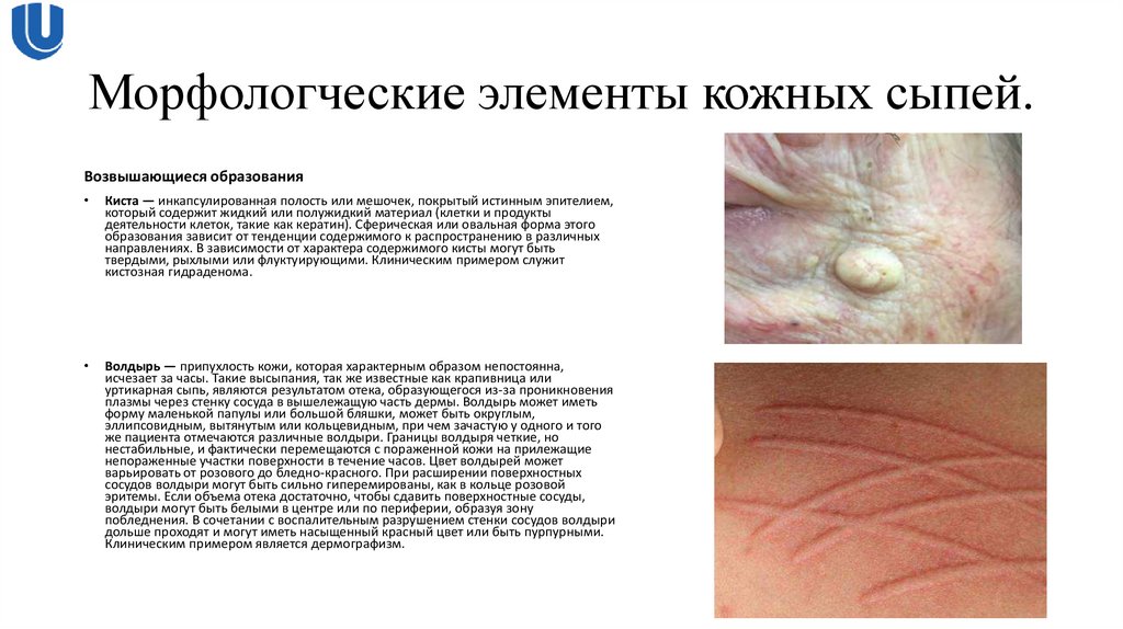 Морфологческие элементы кожных сыпей.