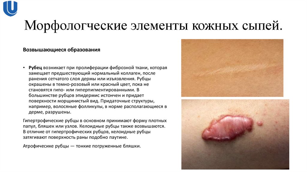 Морфологческие элементы кожных сыпей.