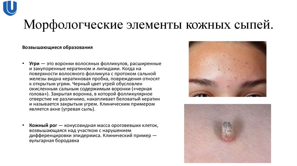 Морфологческие элементы кожных сыпей.