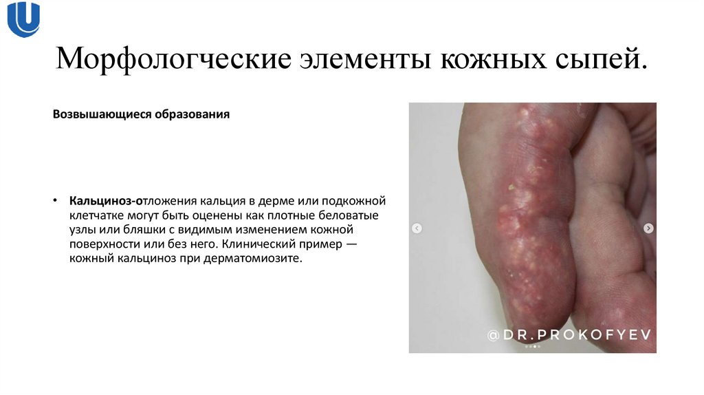 Морфологческие элементы кожных сыпей.
