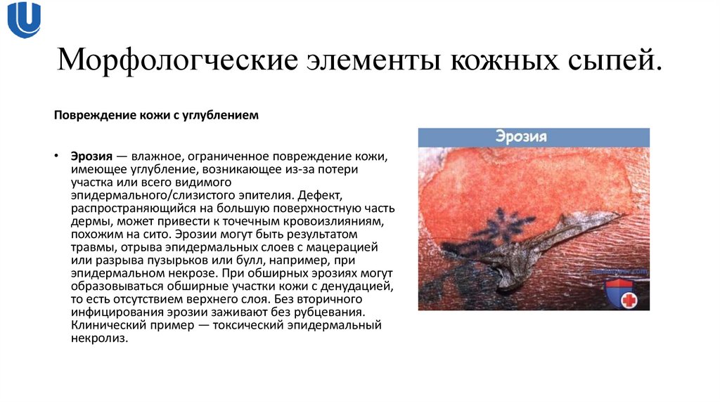 Морфологческие элементы кожных сыпей.