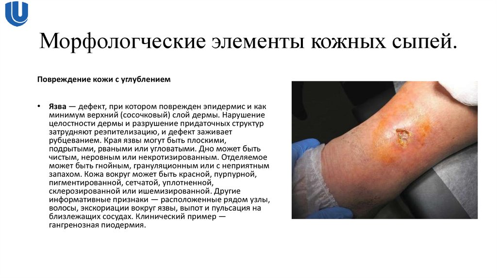 Морфологческие элементы кожных сыпей.