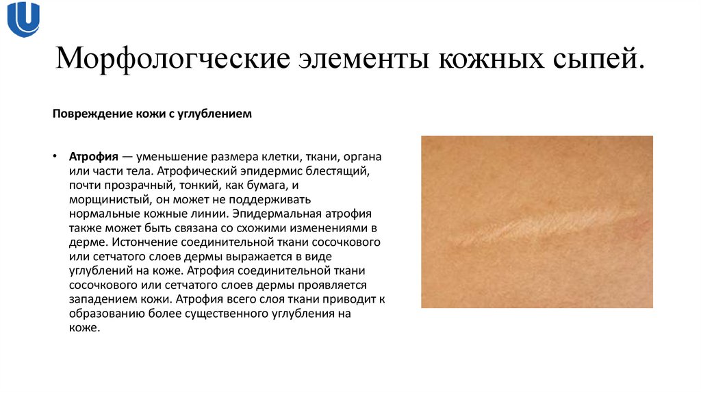 Морфологческие элементы кожных сыпей.