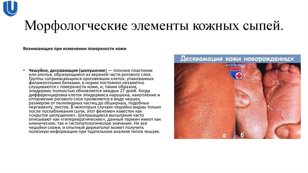 Морфологческие элементы кожных сыпей.