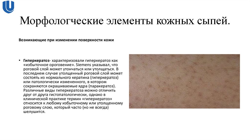 Морфологческие элементы кожных сыпей.