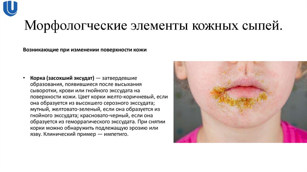 Морфологческие элементы кожных сыпей.