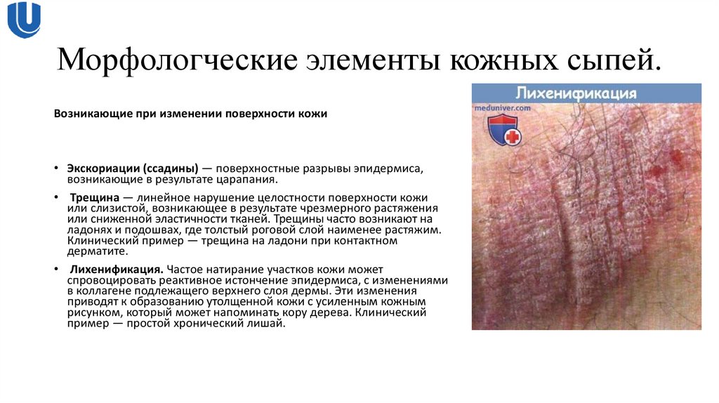 Морфологческие элементы кожных сыпей.