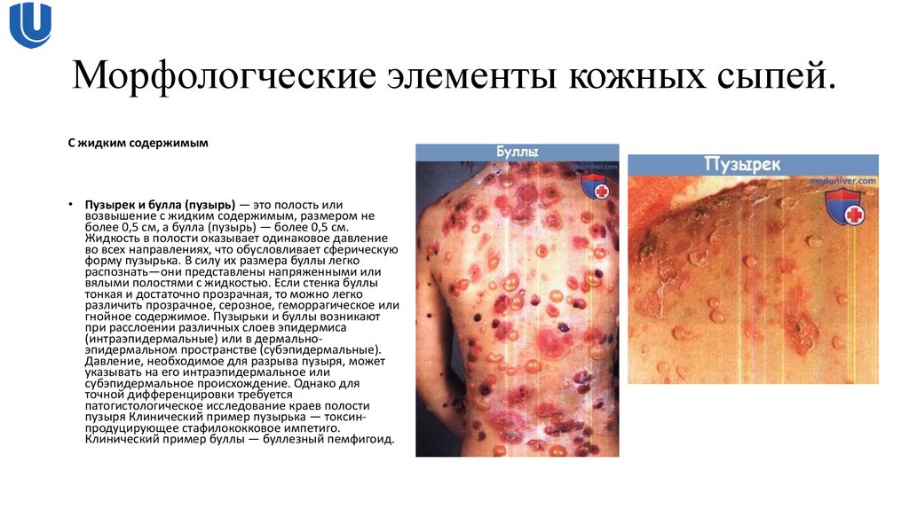 Морфологческие элементы кожных сыпей.