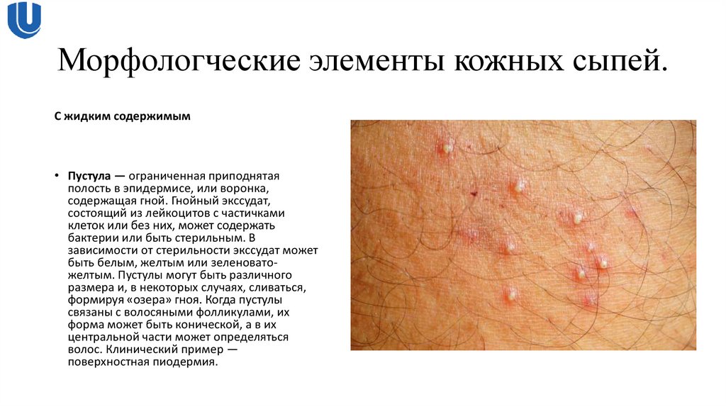 Морфологческие элементы кожных сыпей.