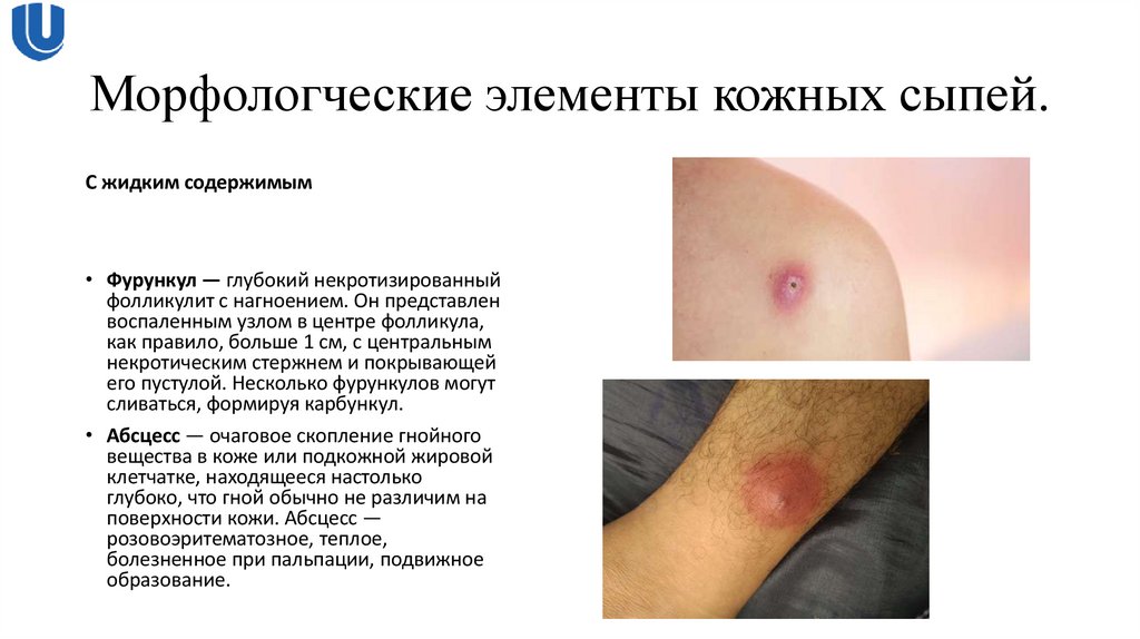 Морфологческие элементы кожных сыпей.