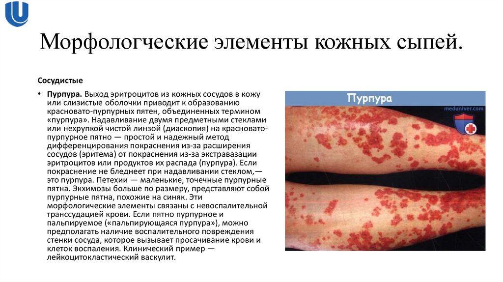 Морфологческие элементы кожных сыпей.