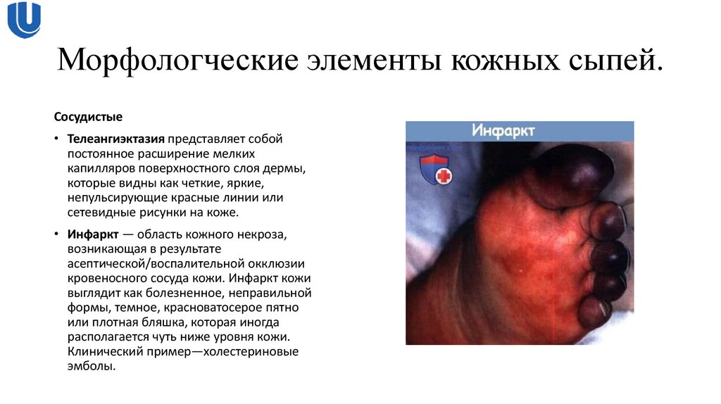 Морфологческие элементы кожных сыпей.