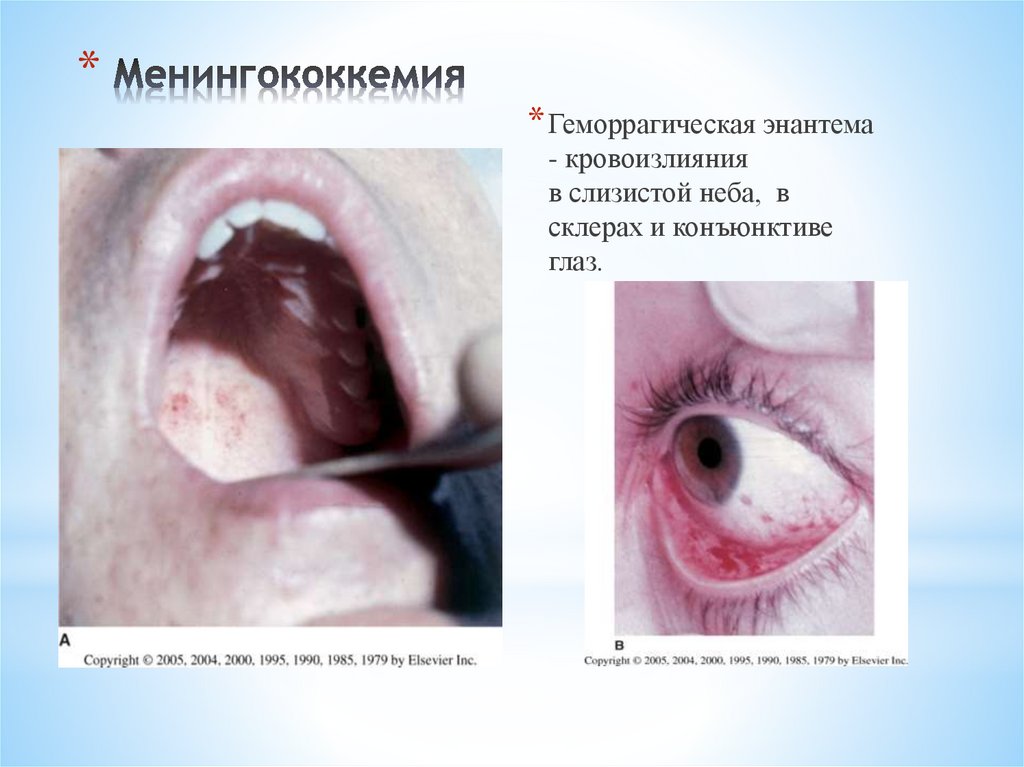 Менингококкемия