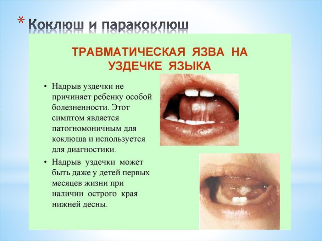 Коклюш и паракоклюш