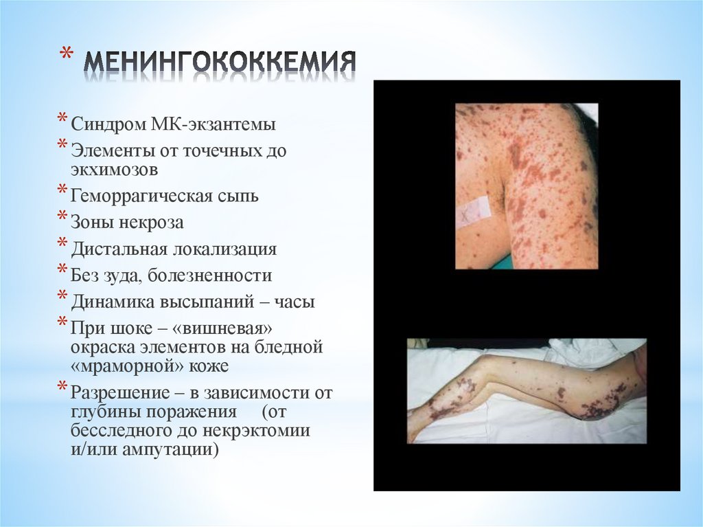 МЕНИНГОКОККЕМИЯ