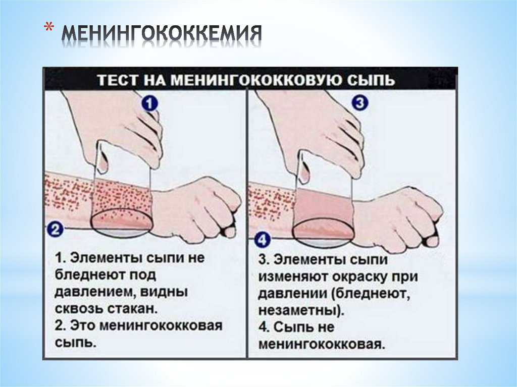 МЕНИНГОКОККЕМИЯ