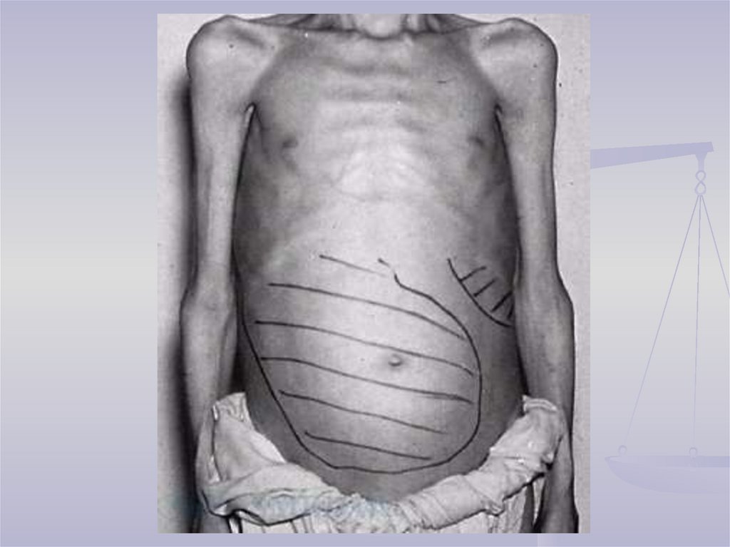 ПАТОГЕНЕЗ ПОРТАЛЬНОЙ ГИПЕРТЕНЗИИ