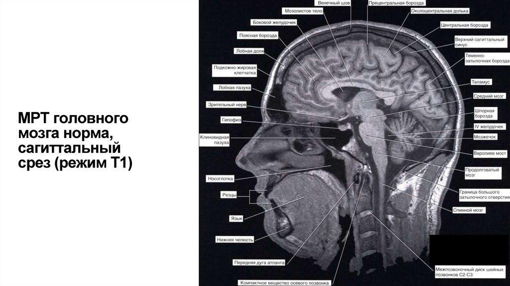 МРТ головного мозга норма, сагиттальный срез (режим Т1)